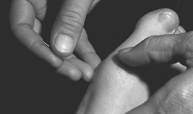 A foot receiving acupuncture